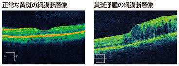 正常な黄斑の網膜断層像、黄斑浮腫の網膜断層像