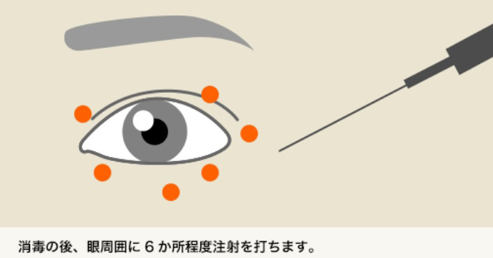 消毒の後、眼周囲に6か所程度注射を打ちます。